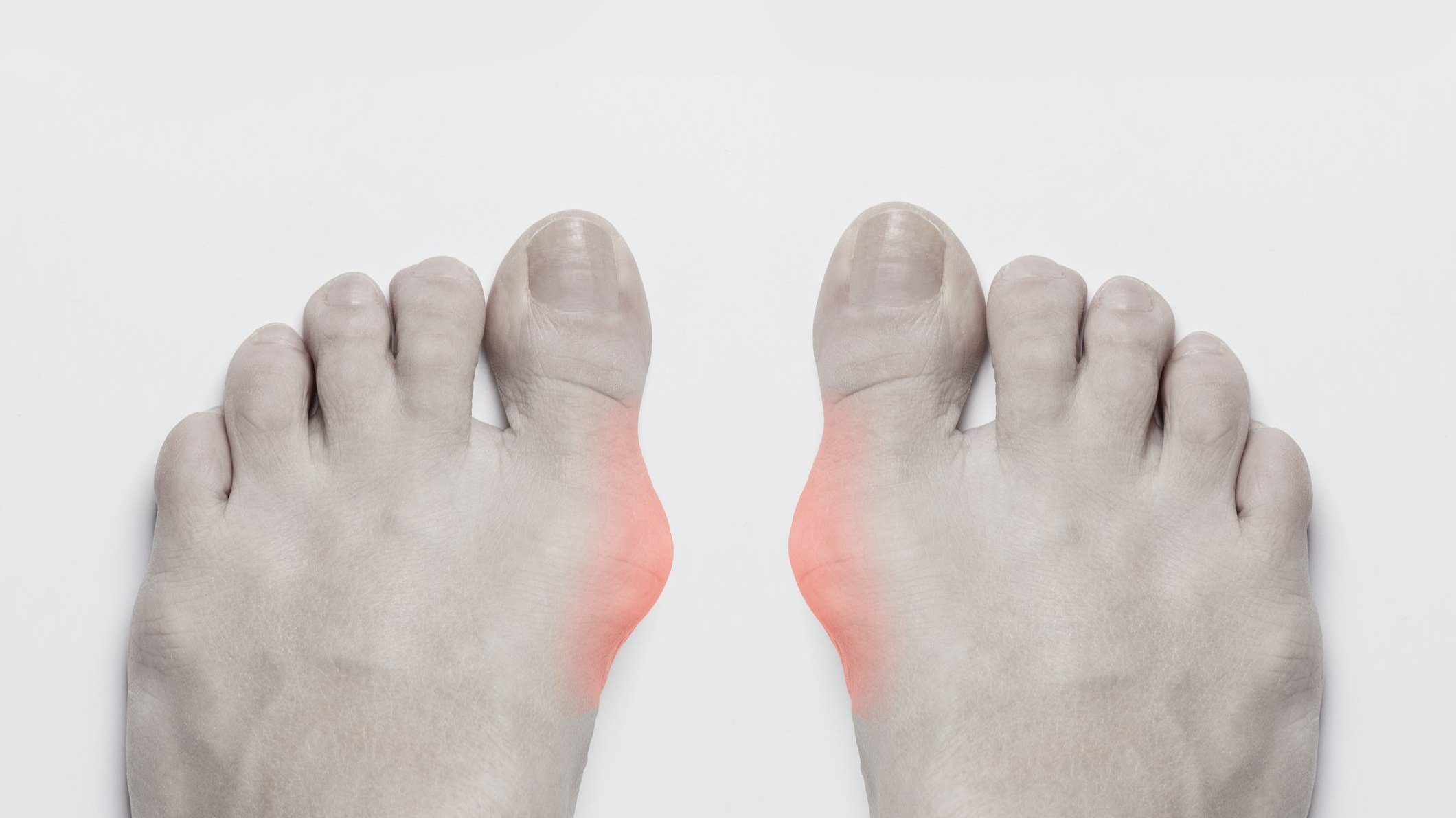 feet with bunion pain