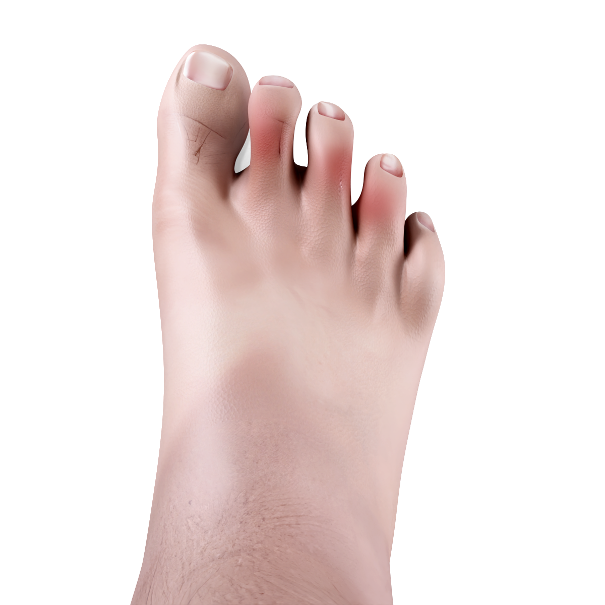 Hammertoe Image