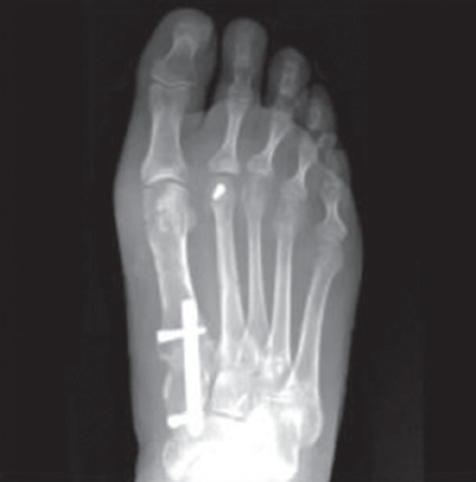 bunion correction xray