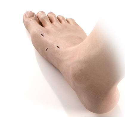 foot with incisions